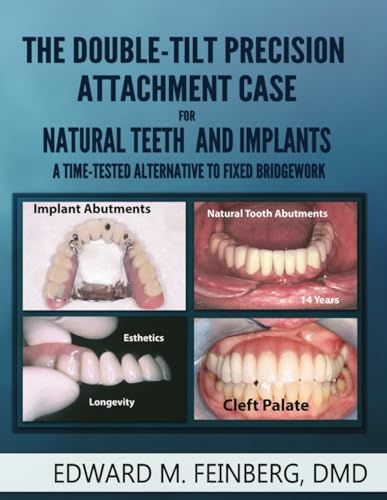 ITI Treatment Guide: Implant Therapy in the Esthetic Zone for